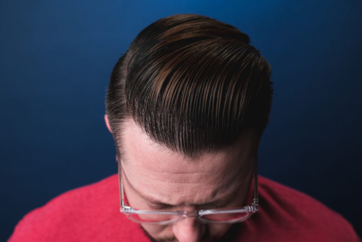 Scalp, Men, Men's Hair